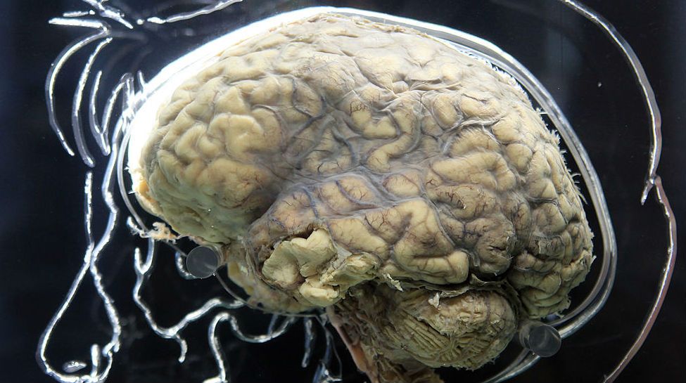 Human brains show larger-than-life activity at moment of death