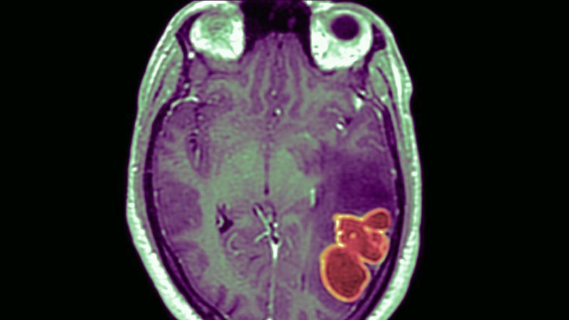 Brain abscesses increased nationally in children last winter but remain rare, new CDC investigation finds