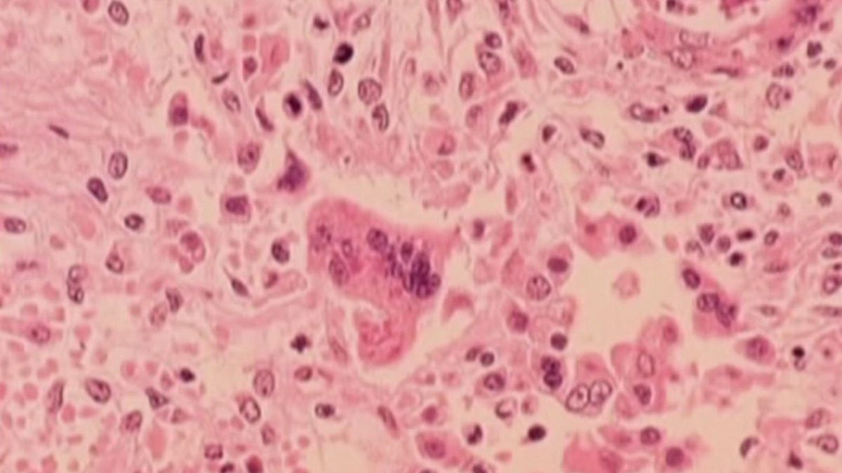 Possible measles exposure at PHL, health department says