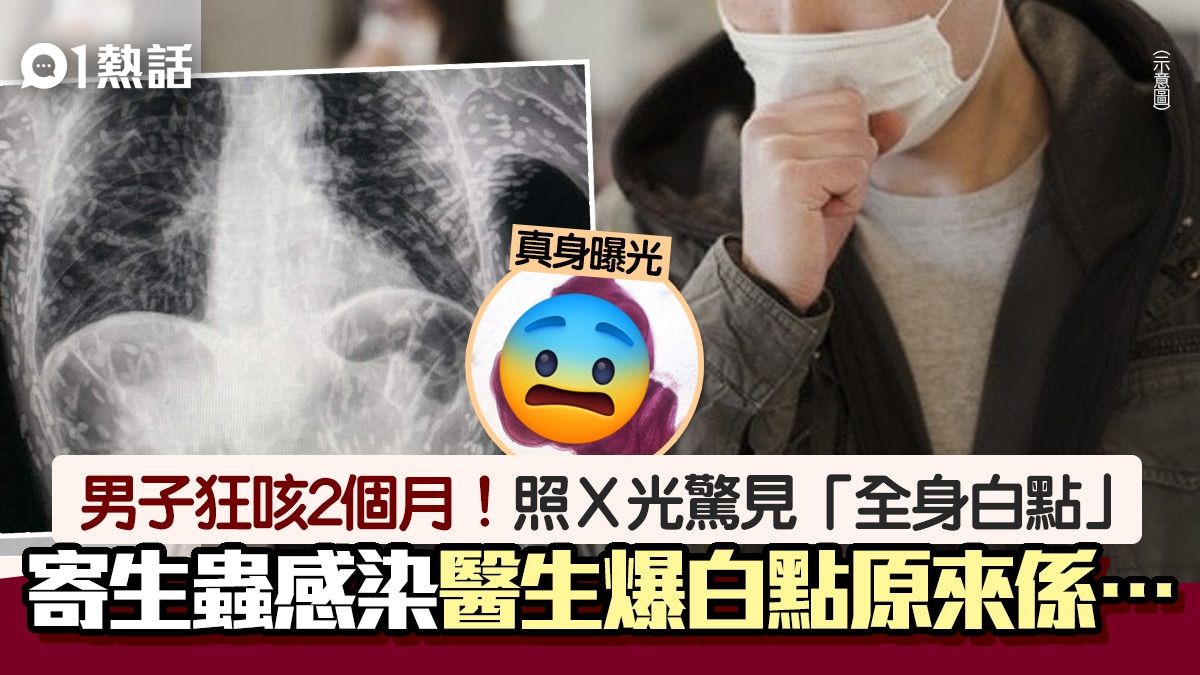 男子咳嗽2個月！照Ｘ光見全身長滿寄生蟲 肺部白點真身竟是…