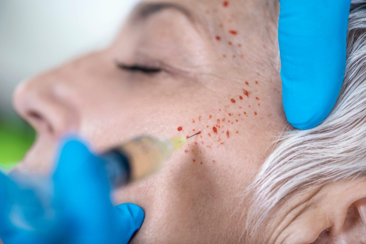 More HIV cases linked to "vampire facial" clinic