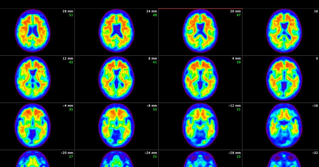 Advisory Panel of Experts Endorses F.D.A. Approval of New Alzheimer’s Drug