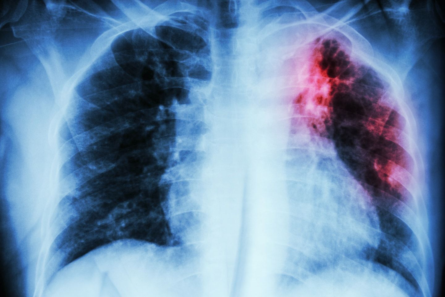 More than 500 children exposed, tested for tuberculosis in Nebraska