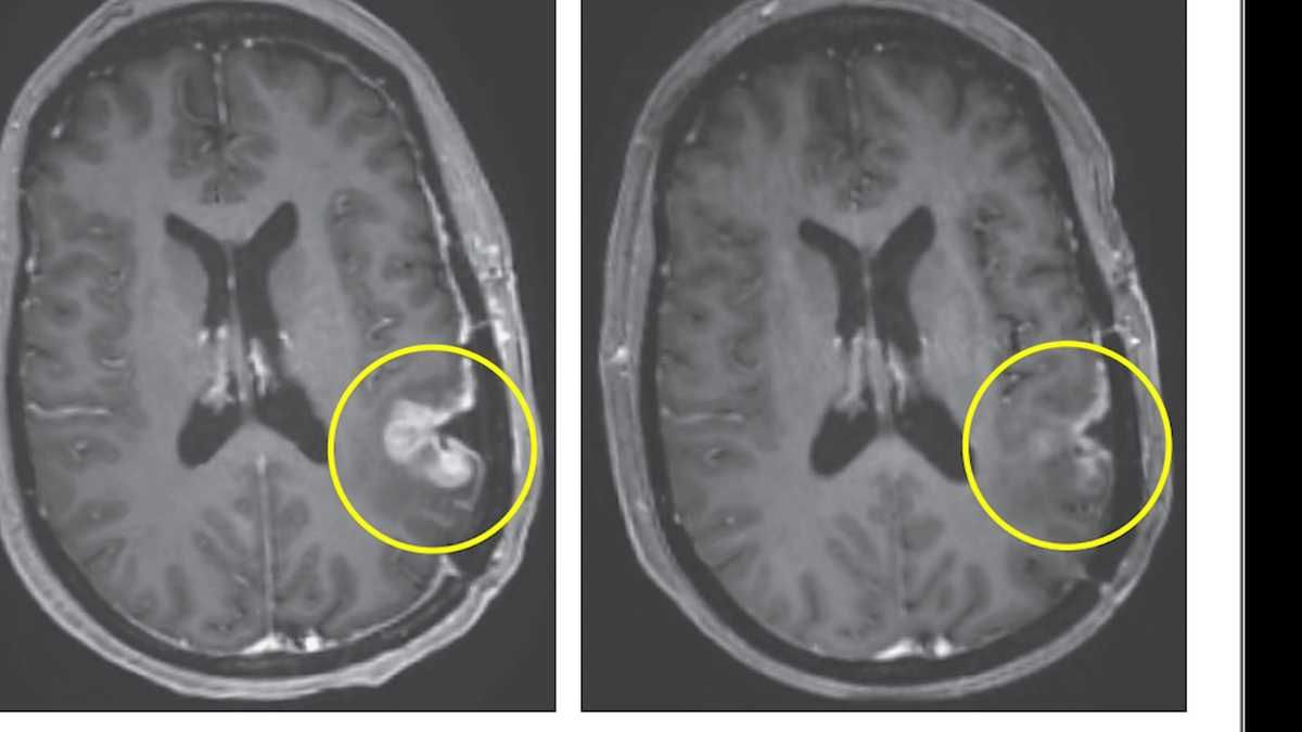 Massachusetts clinical trial shows 'dramatic and rapid' progress against glioblastoma tumors