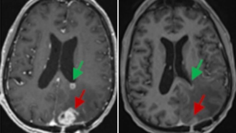 Living drugs that reprogram patients’ immune cells show early promise against hard-to-treat brain tumors