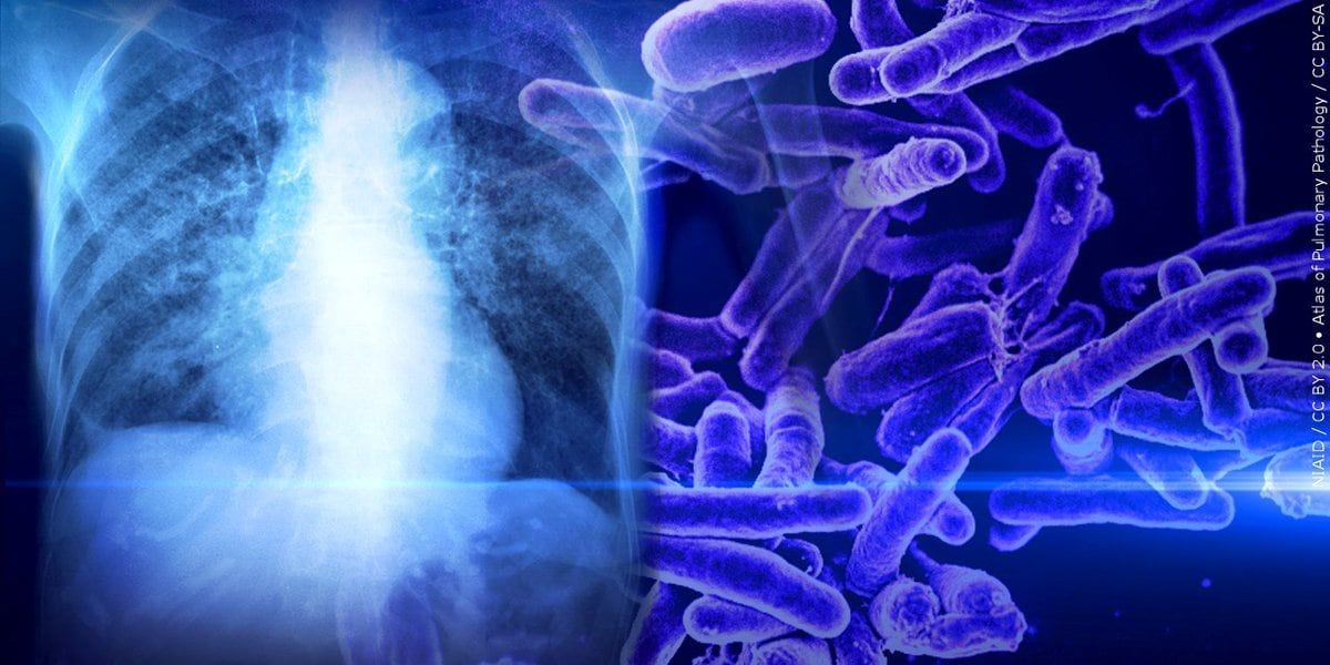 Douglas County declares public health emergency after tuberculosis exposures