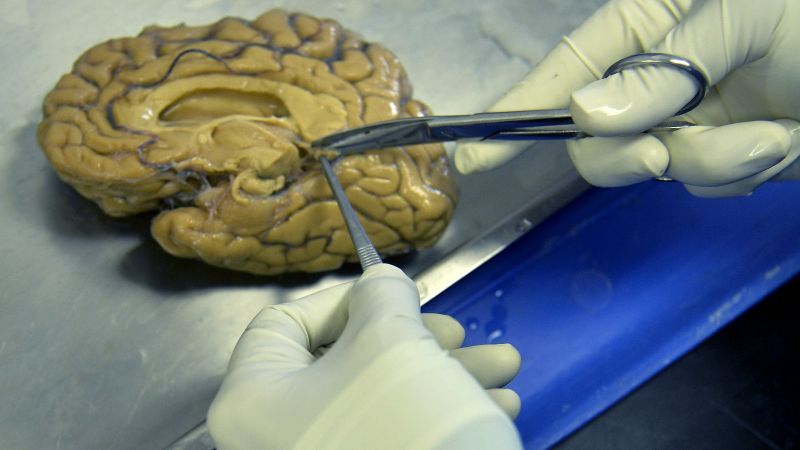 Man who defied genetics for decades may hold a clue to preventing Alzheimer's, scientists say