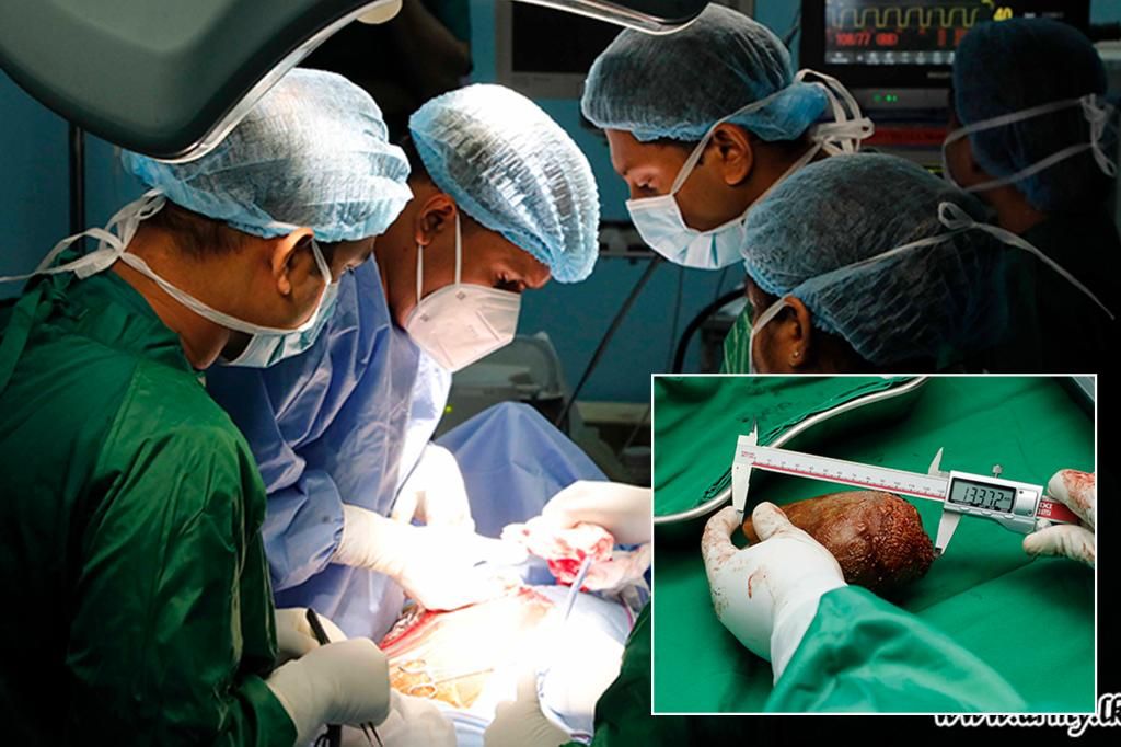 Doctors in Sri Lanka remove ‘world’s largest' kidney stone that's the size of a grapefruit