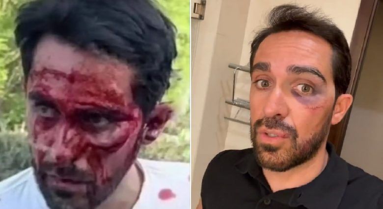 Points de sutures, visage en sang... Alberto Contador a rassuré !