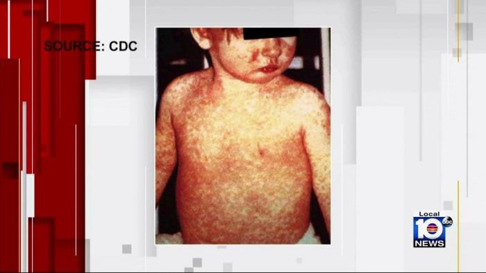 Officials report 5th measles case at Broward elementary school