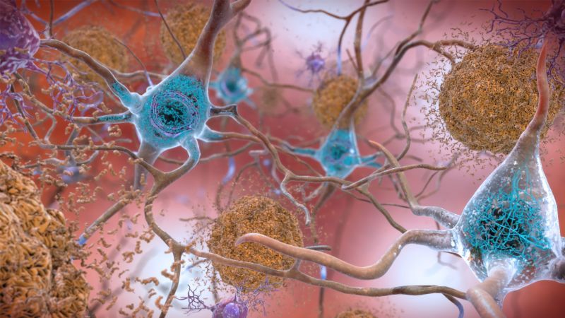 Anti-amyloid therapy may keep Alzheimer’s symptoms at bay in certain patients, study suggests