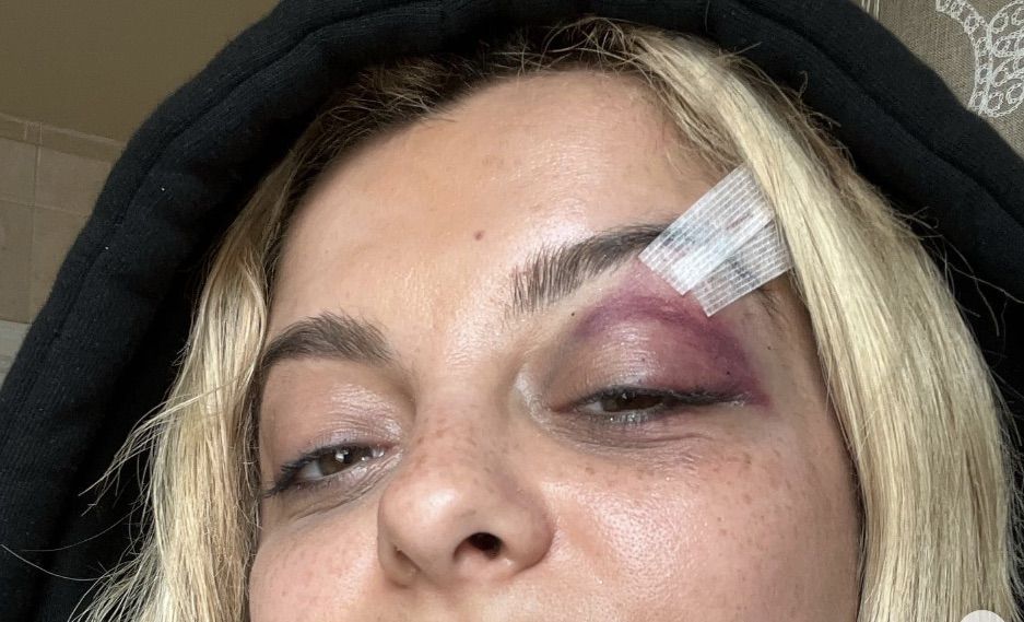 Singer Bebe Rexha Struck In Face By Tossed Cell Phone At NYC Concert