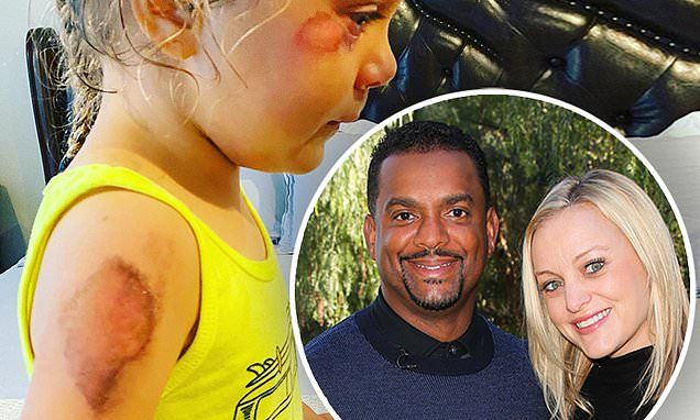 Alfonso Ribeiro's daughter Ava is 'doing better each day' after a scary scooter accident