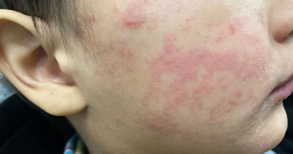 Measles warning issued for Texas State University as outbreak reaches San Marcos