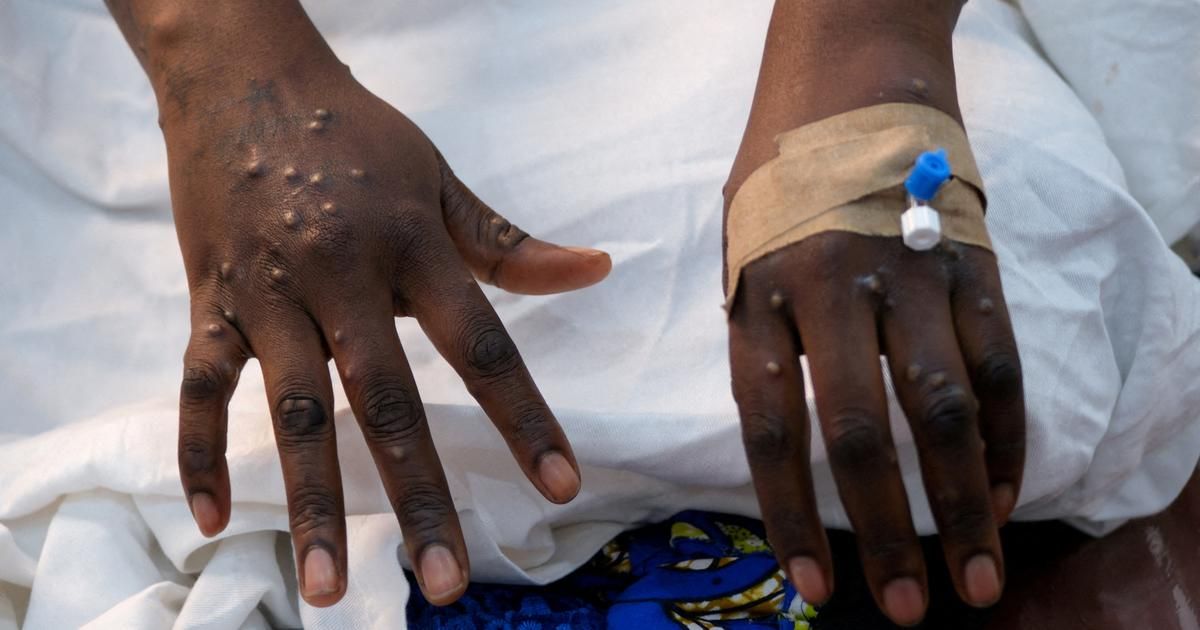 Mpox: le nouveau variant se transmet surtout entre humains