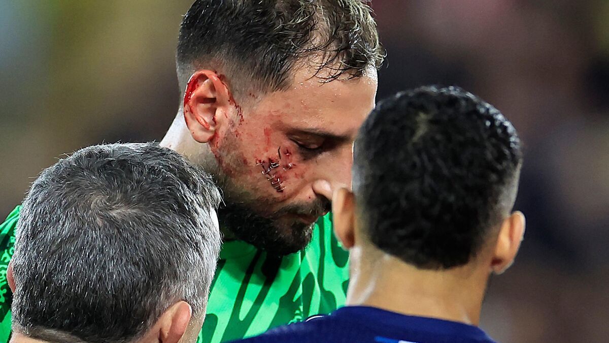 PSG : les images de la balafre de Gianluigi Donnarumma, blessé par le Monégasque Wilfried Singo