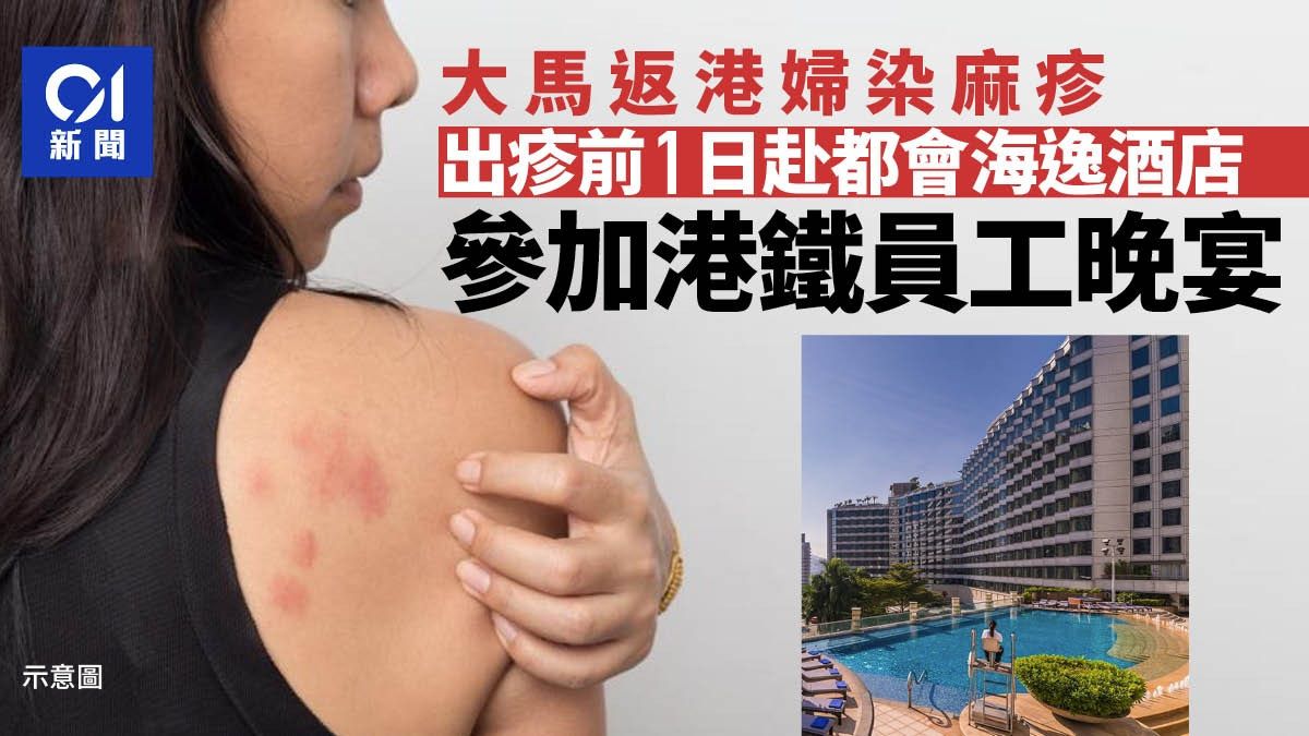 麻疹｜大馬返港婦確診 出疹前曾到都會海逸酒店參加港鐵員工晚宴