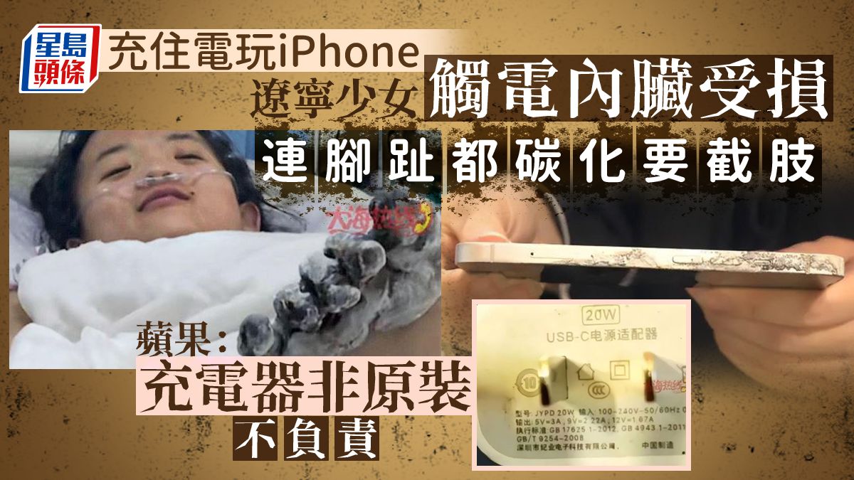 遼寧少女玩iPhone漏電要截肢 蘋果：充電器非原裝 銷售方：只能賠一個