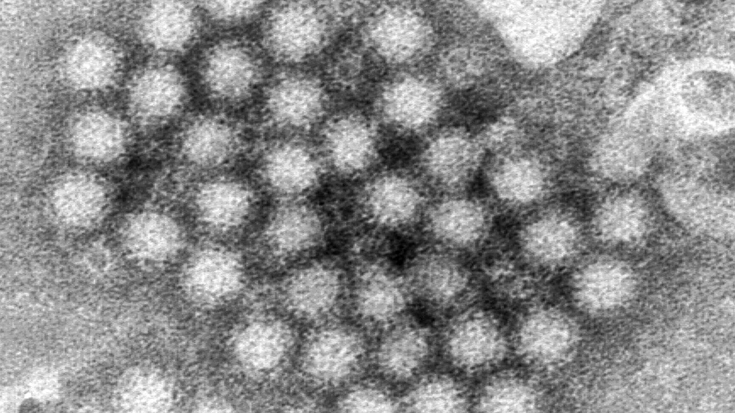 Norovirus cases are surging in the U.S., CDC data shows