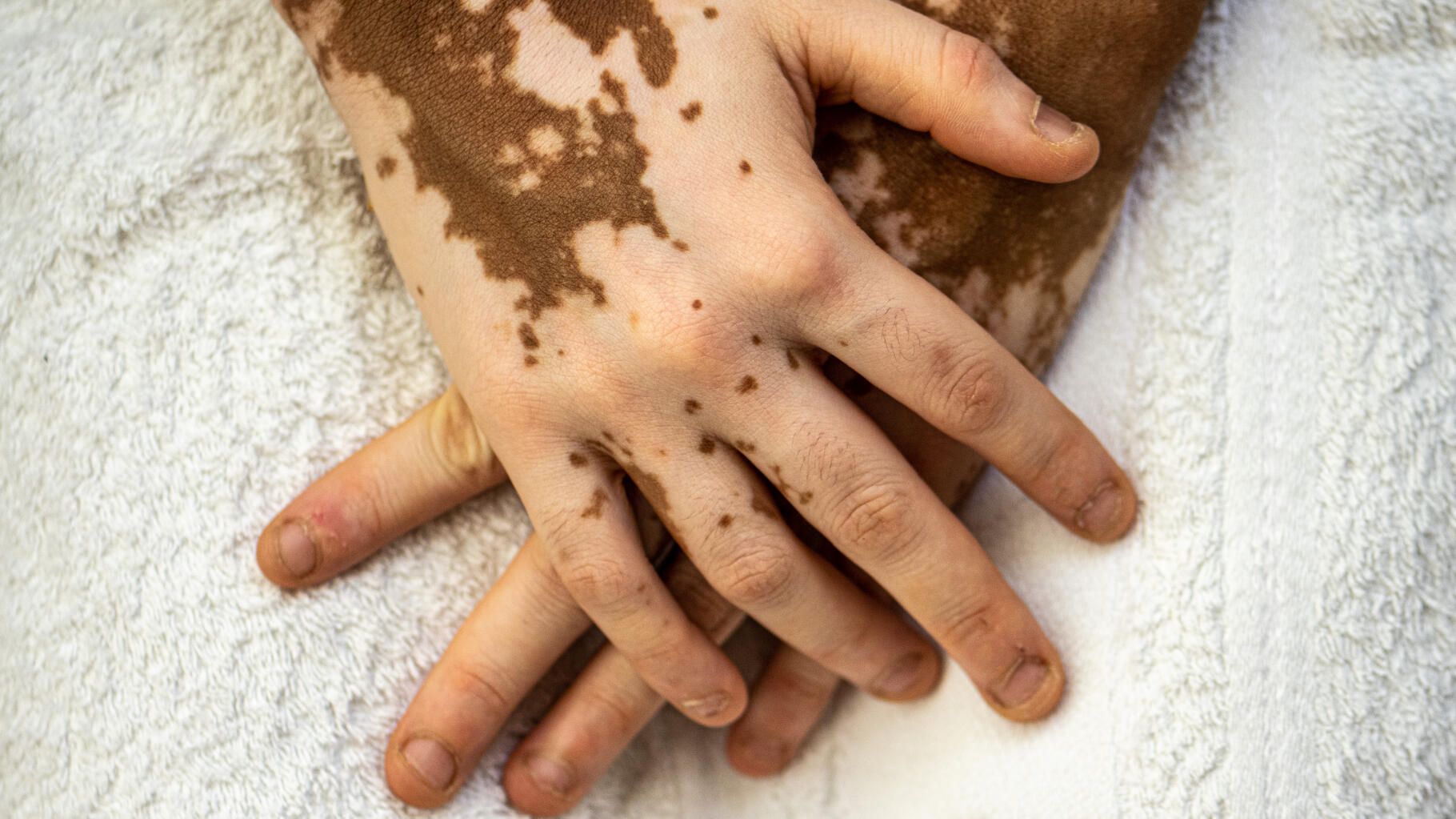 Les Français atteints de vitiligo ont désormais accès à un traitement remboursé